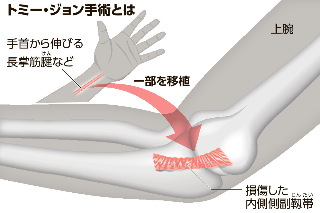 トミージョン手術2回目の真実！大谷翔平の球速と復帰率を完全解剖