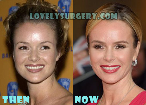 Amanda Holden Face Before and After