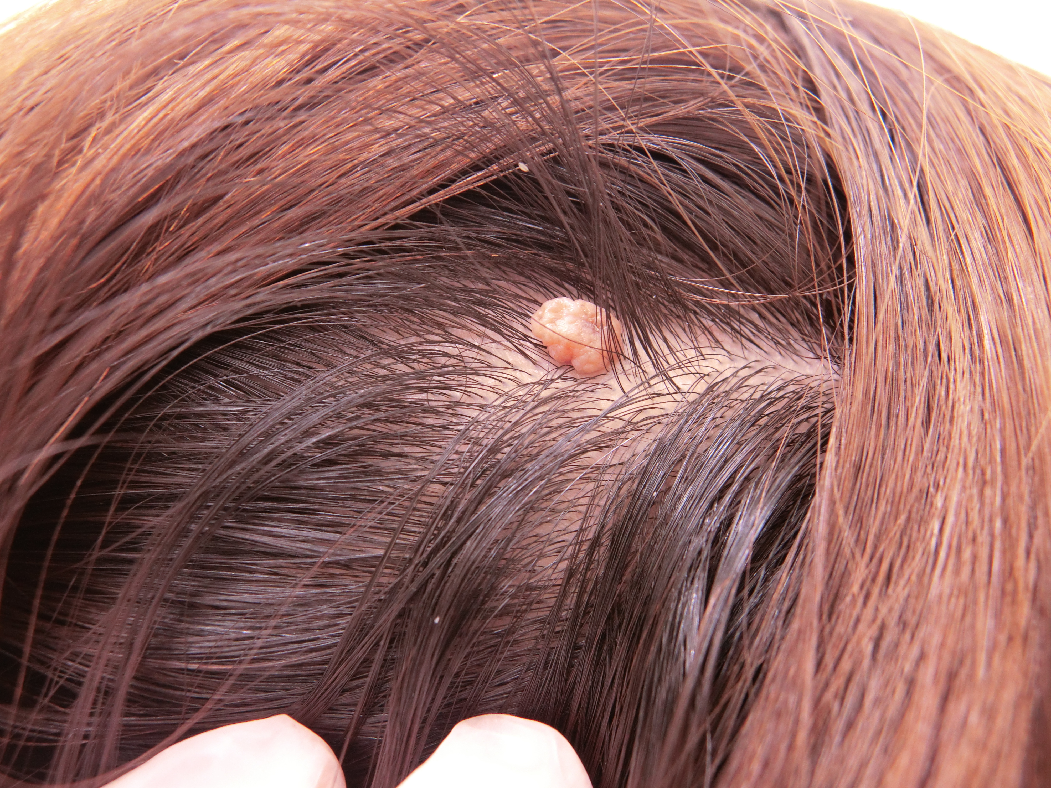 頭のイボ除去は自分で取るな！皮膚科の保険適用費用と悪性の見分け方