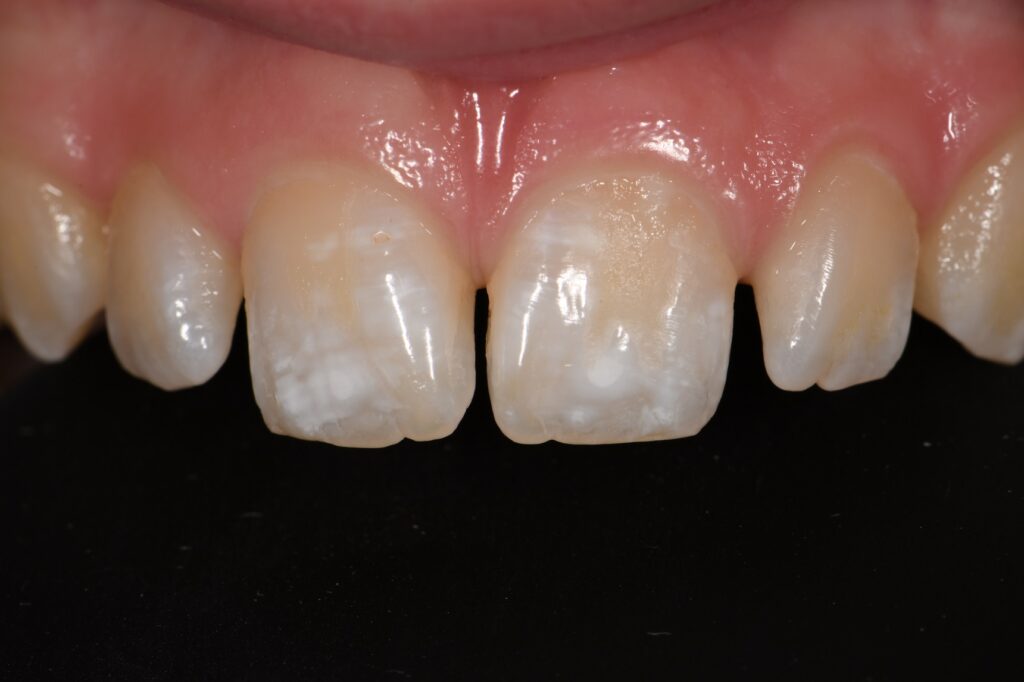Resin Infiltration for White Spot Lesions