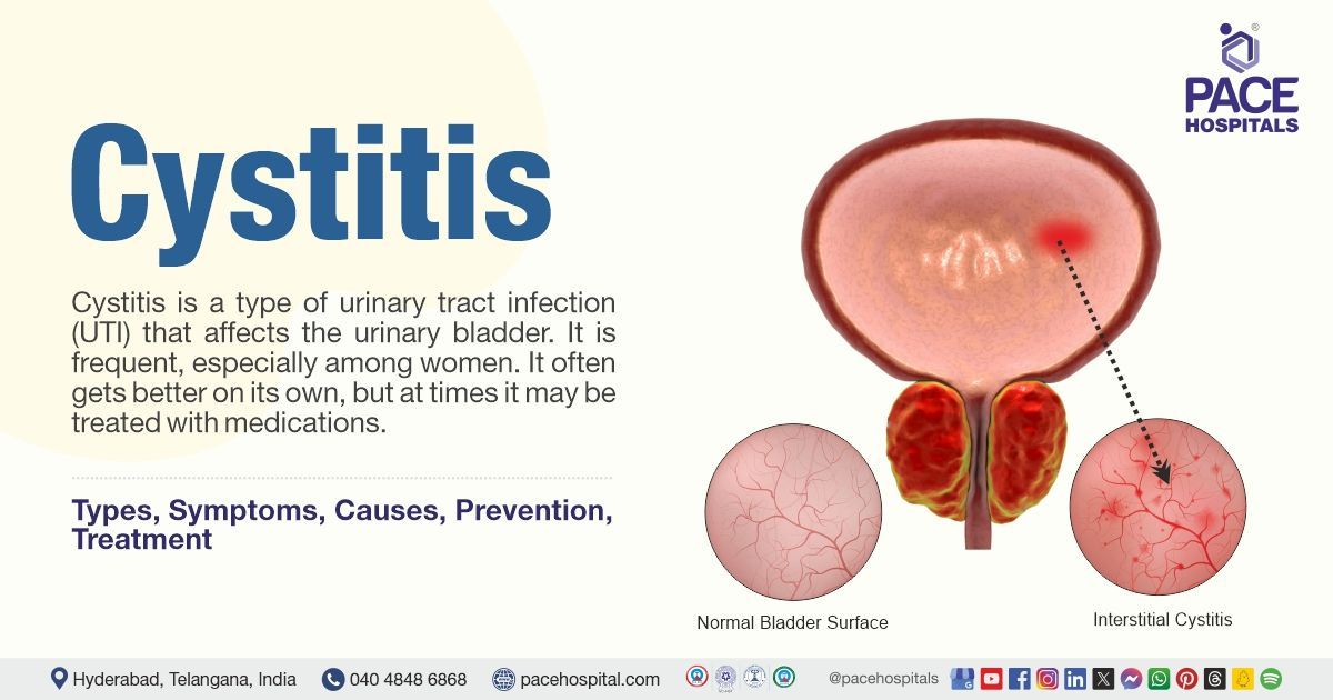 Will Cystitis Go Away on Its Own