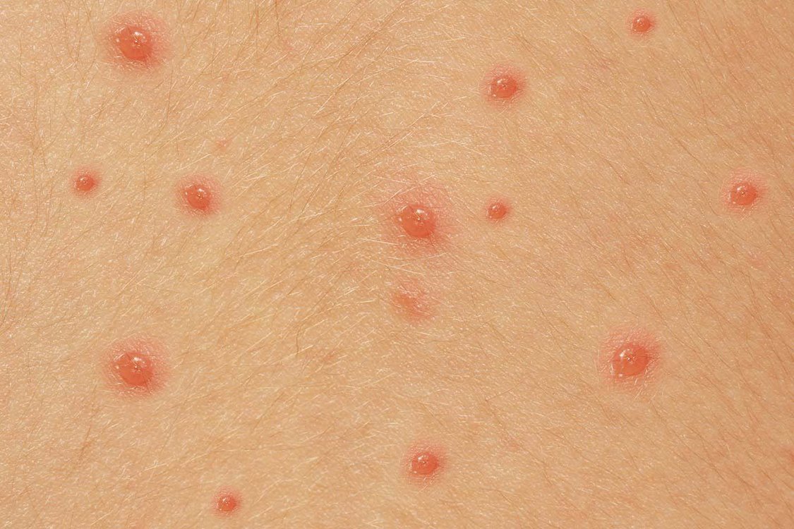 What Do Chickenpox Spots Look Like