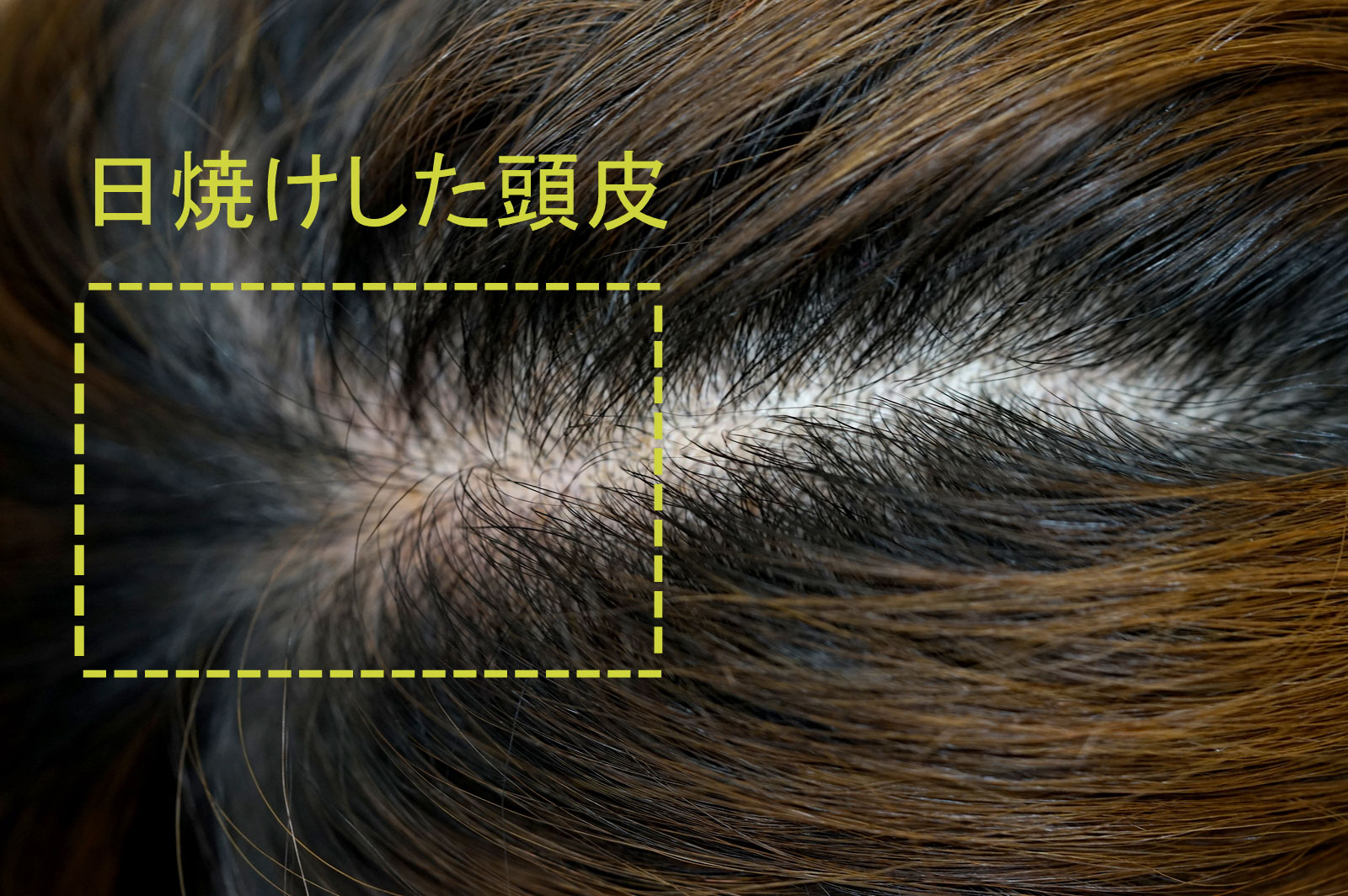 頭皮の日焼けを放置すると薄毛に？赤み・皮剥けの緊急対策とNg行動