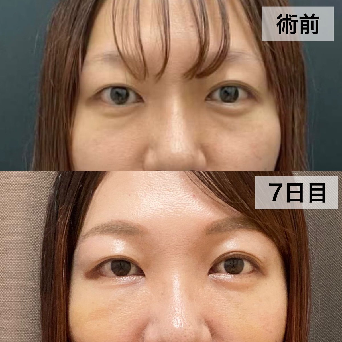 レーシックで目つきが変わる噂の真相！顔の印象変化と後悔を防ぐ鉄則