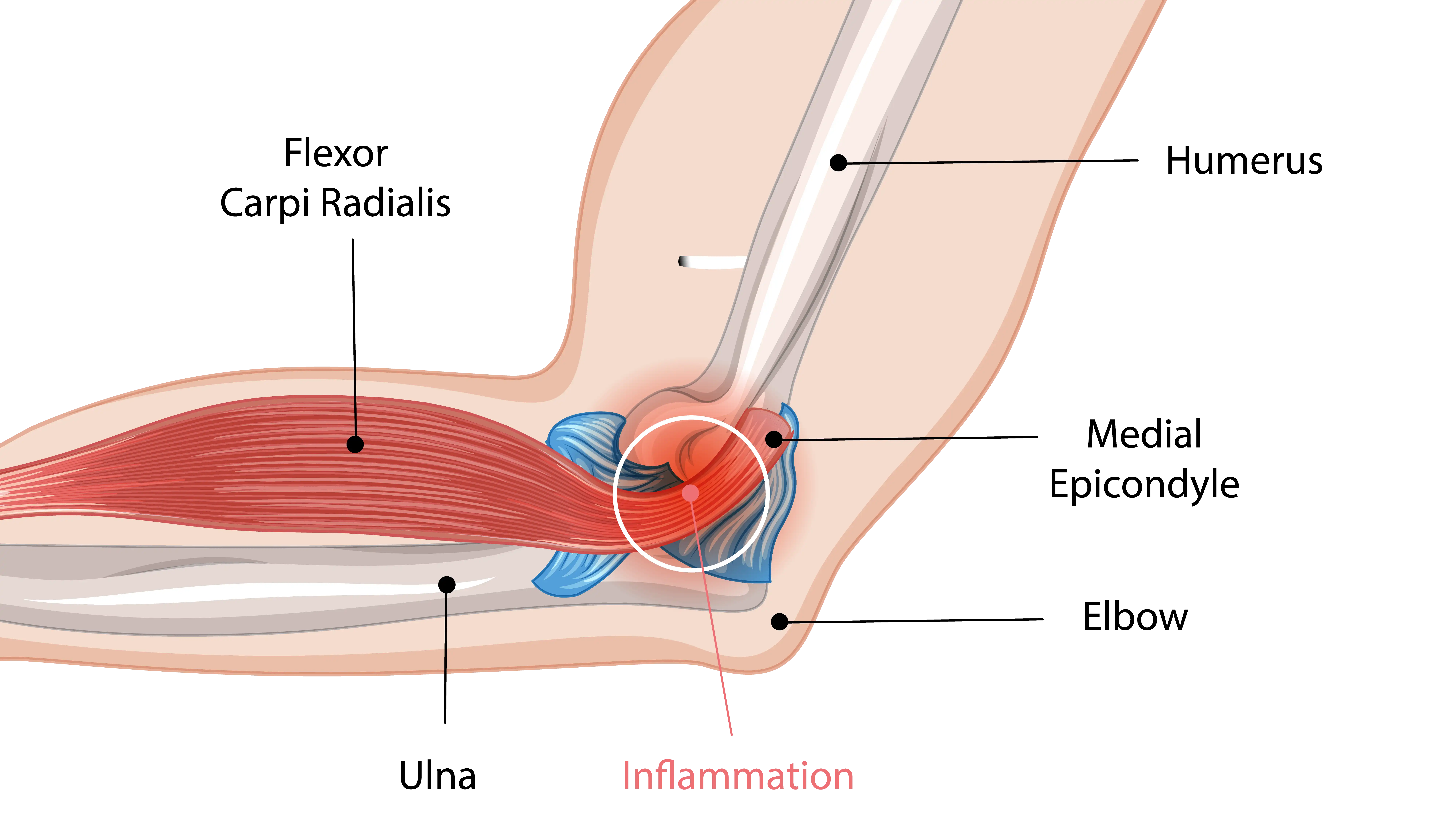 Burning Pain Inside Elbow