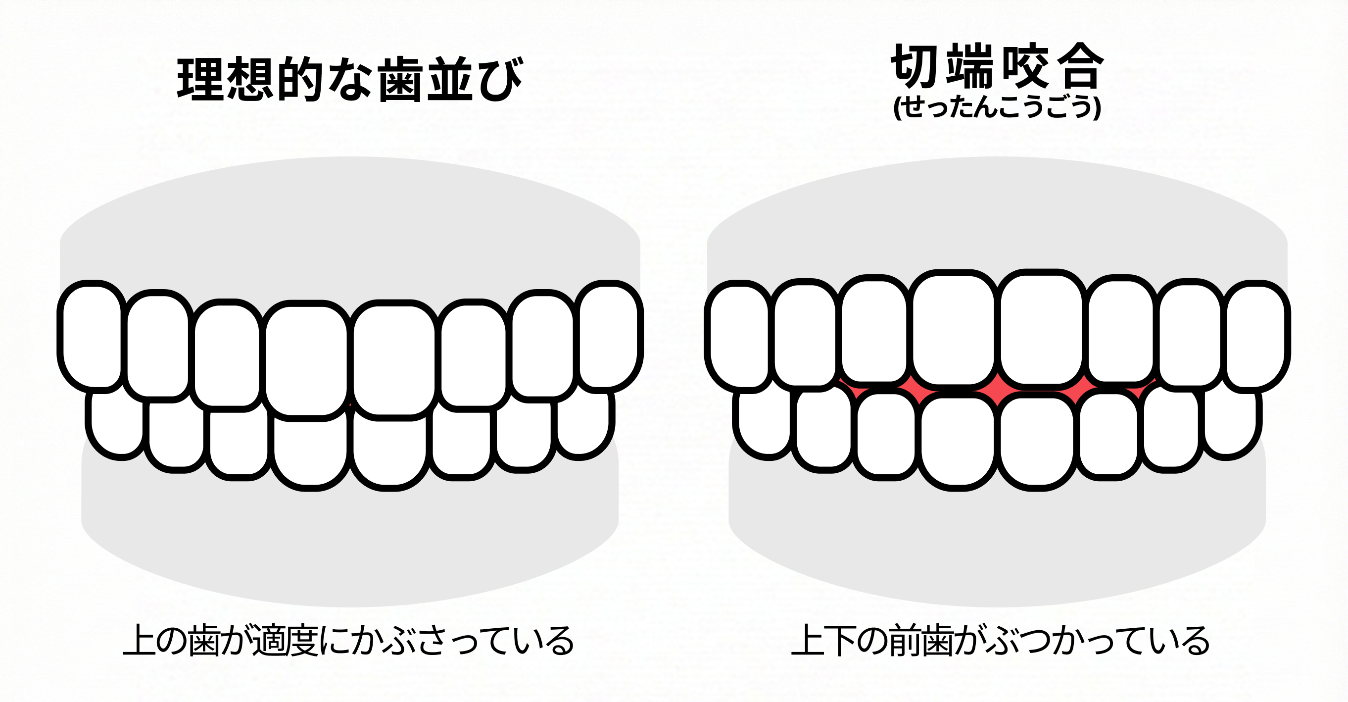 前歯が当たる切端咬合とは？放置リスクと自力改善の罠・矯正費用相場