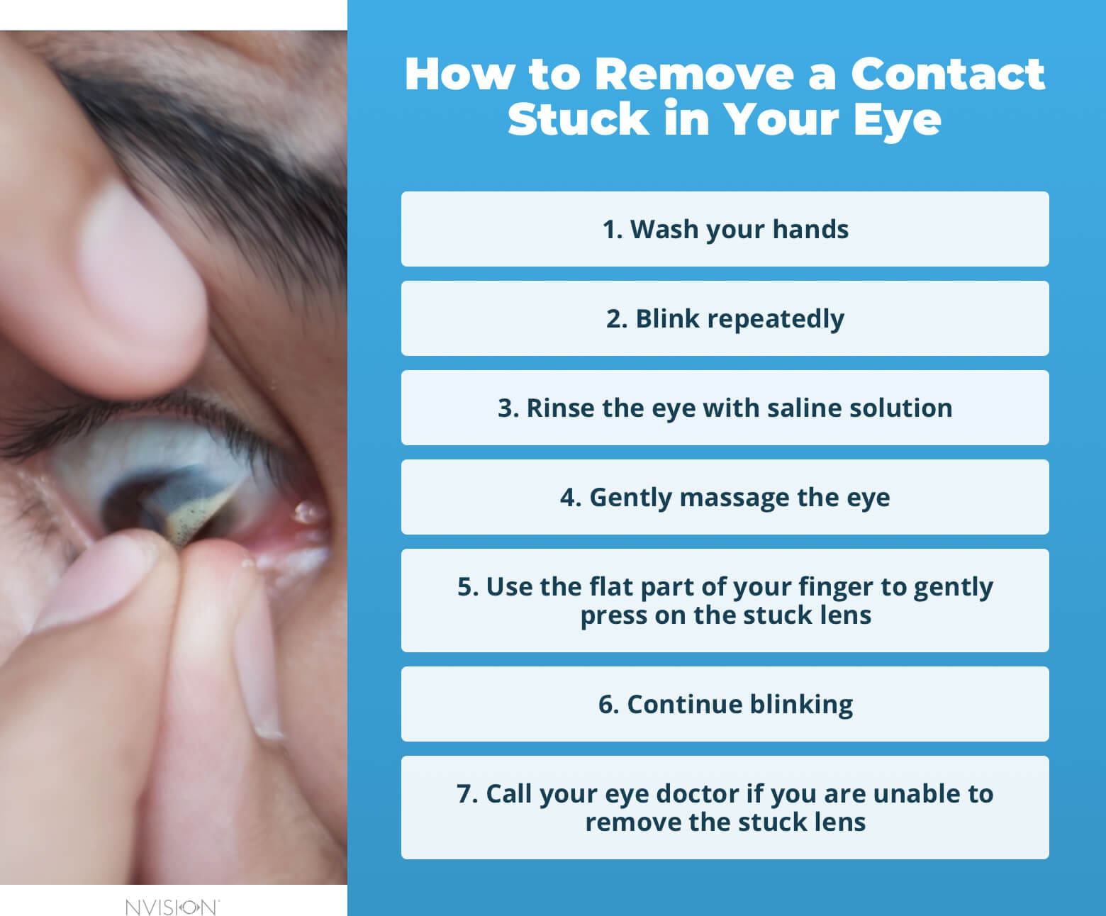 Losing a Contact in Your Eye
