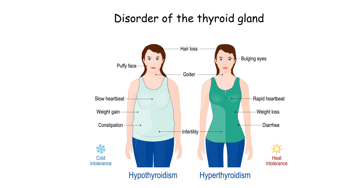Hypothyroidism and Belly Fat