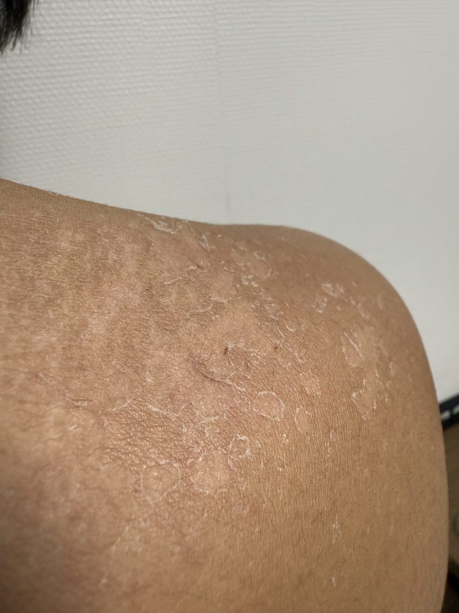日焼けの皮むけ無理に剥がすな！痕を残さず治す最新の応急修復法