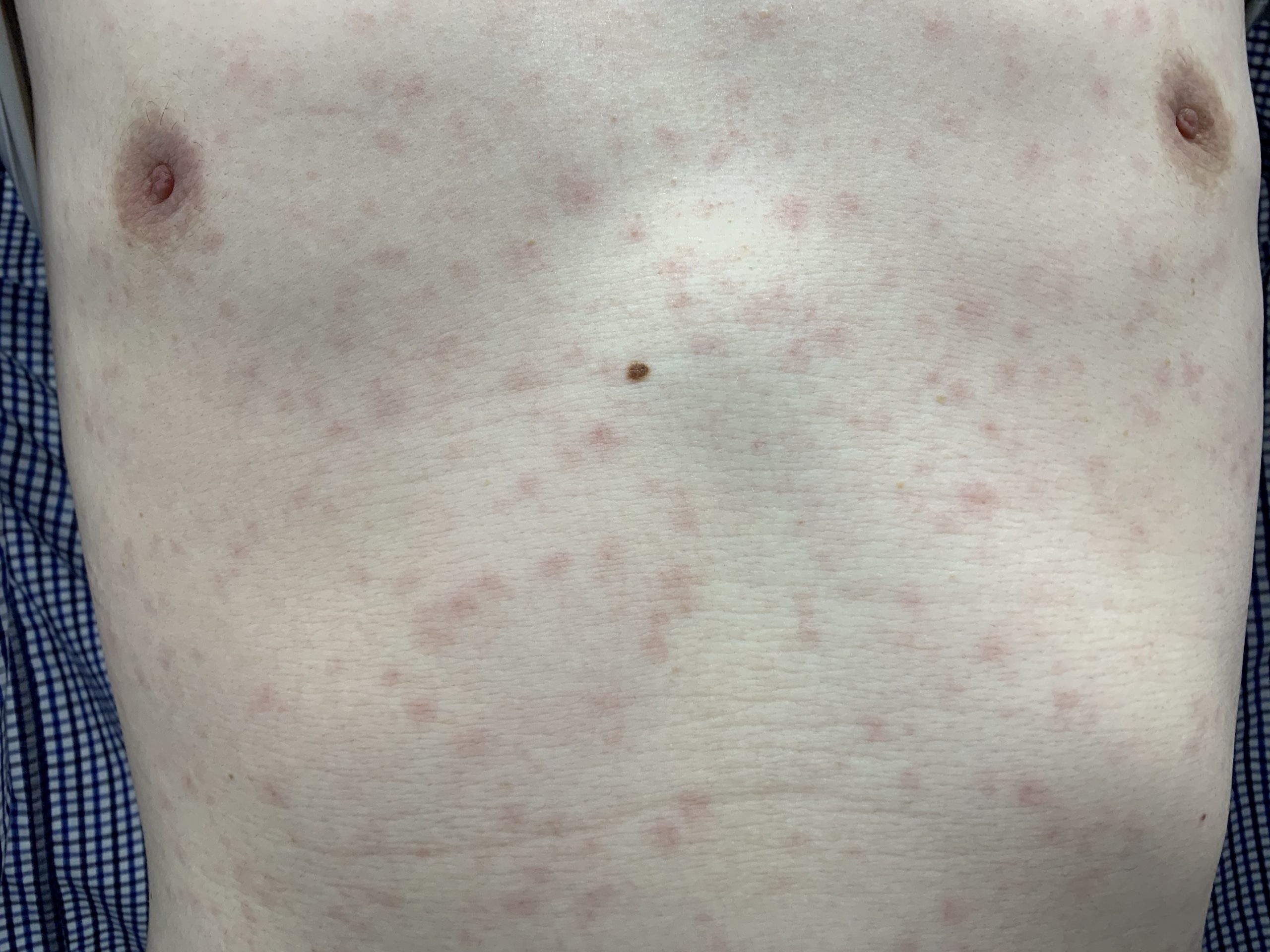 梅毒の抗体は一生残る？治療後の陽性理由と完治の真実を徹底解剖