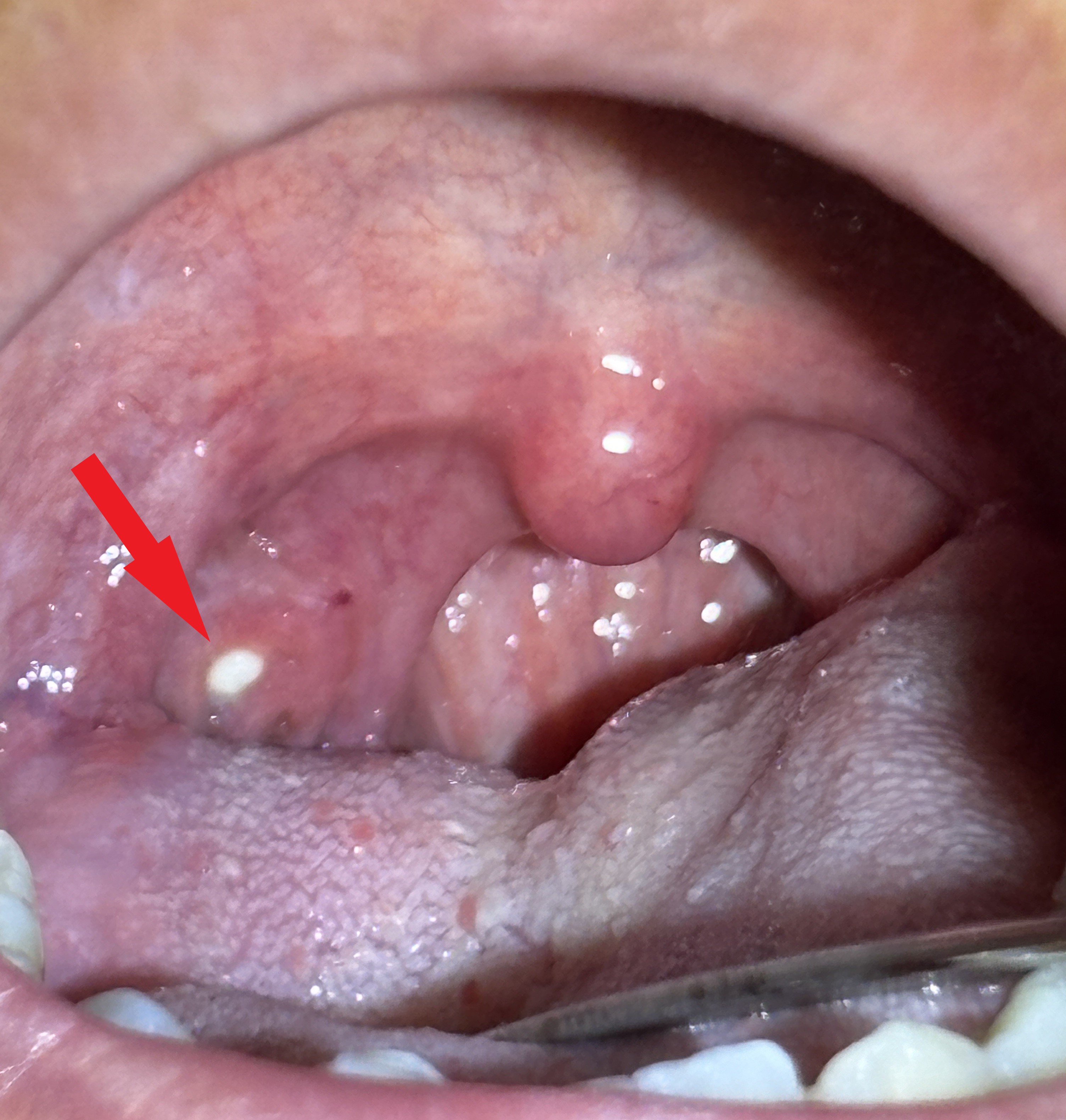 喉の奥が白い正体とは？臭い玉・扁桃炎の見分け方とNgな除去法を完全解説