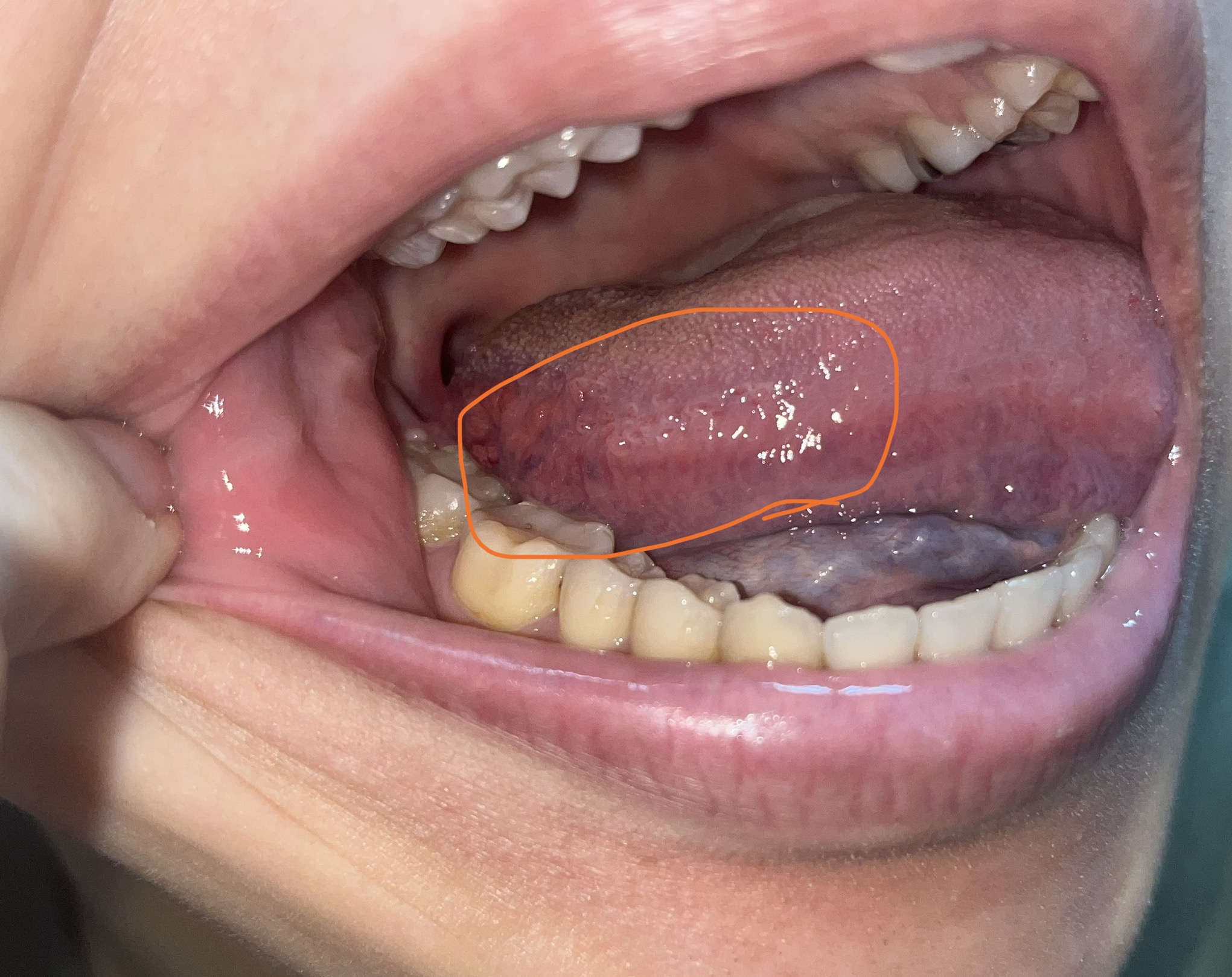 ベロの右側が痛い原因は？口内炎と舌癌の見分け方や受診科を徹底解説