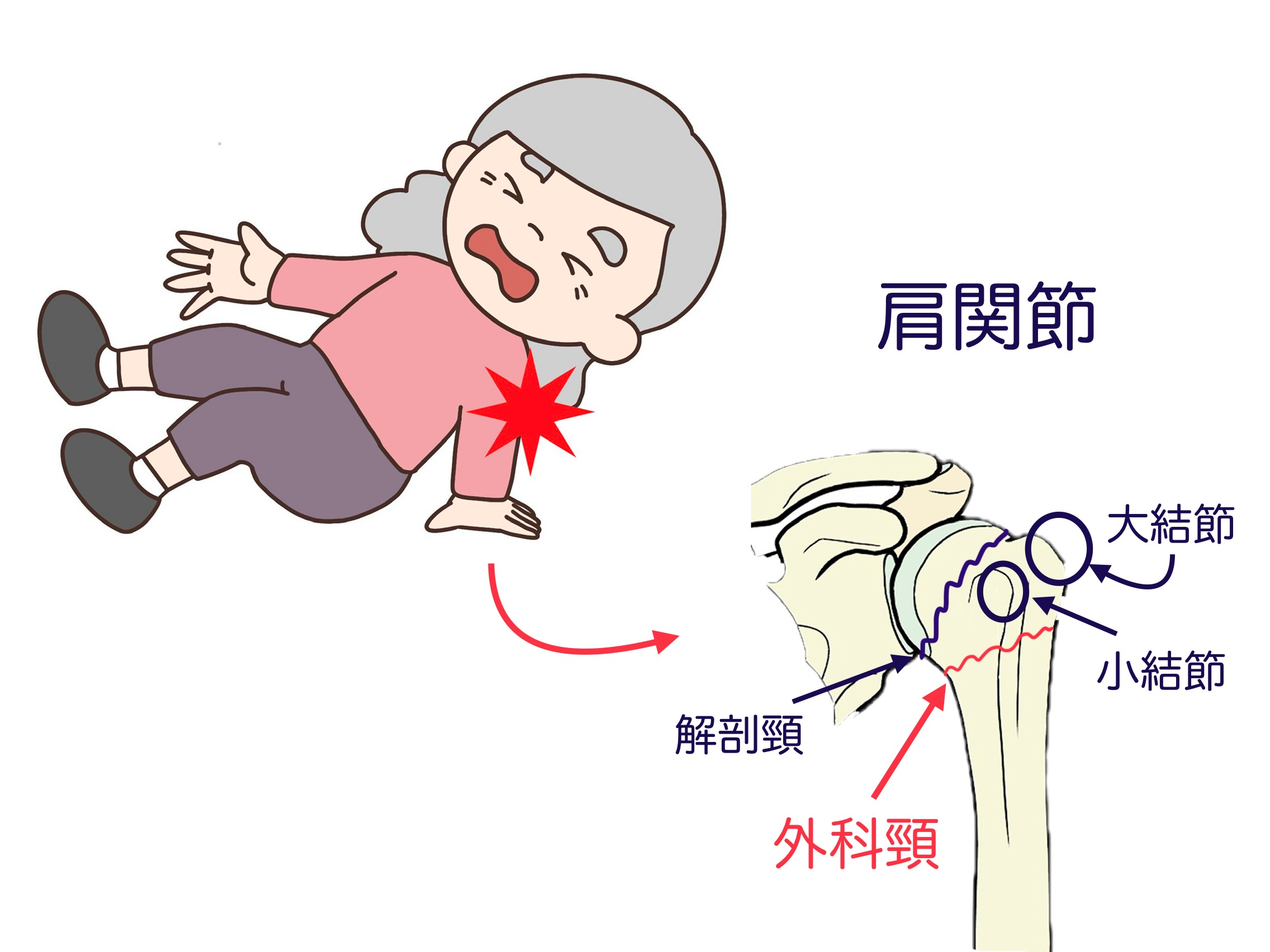 上腕骨外科頚骨折の手術と保存の分岐点｜全治までの期間と後遺症予防策