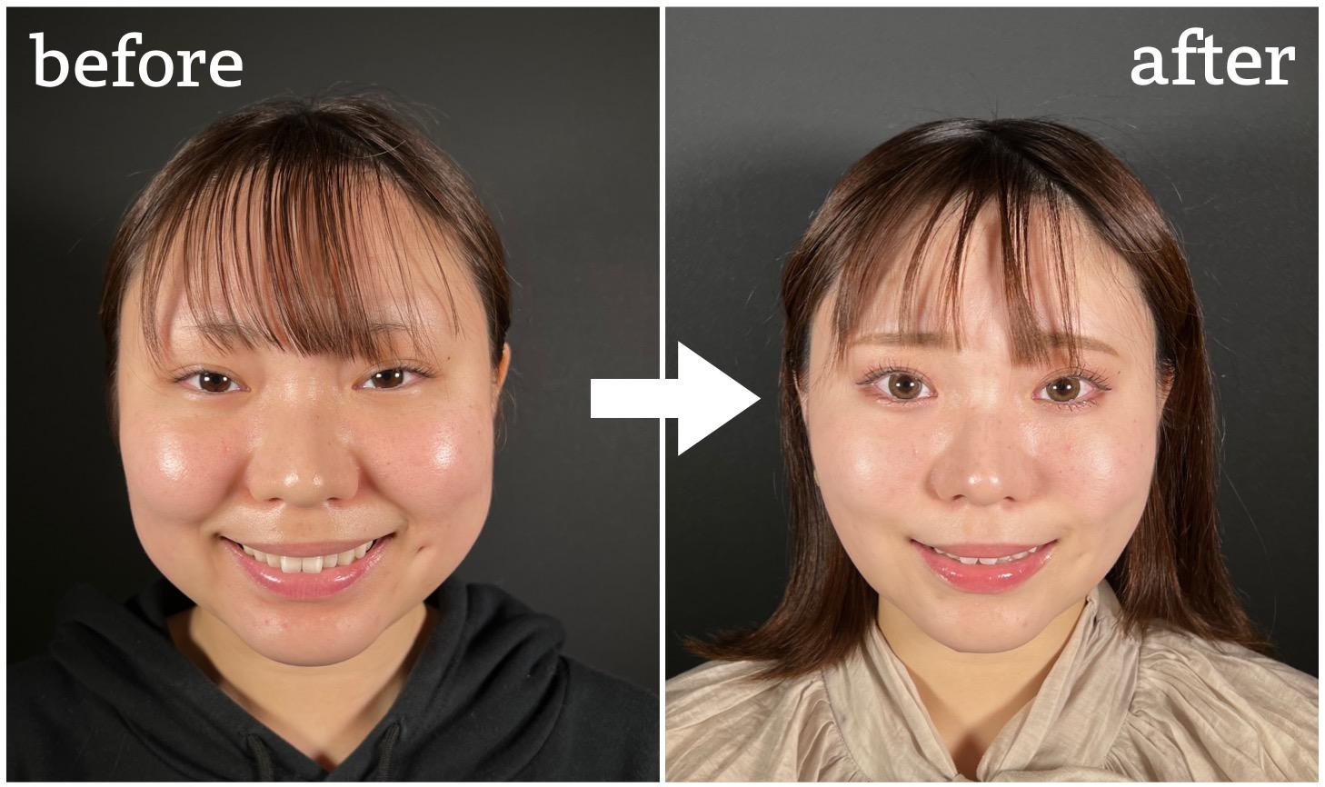 笑うと頬が盛り上がる原因は？アンパンマン顔を解消する整形と失敗回避法