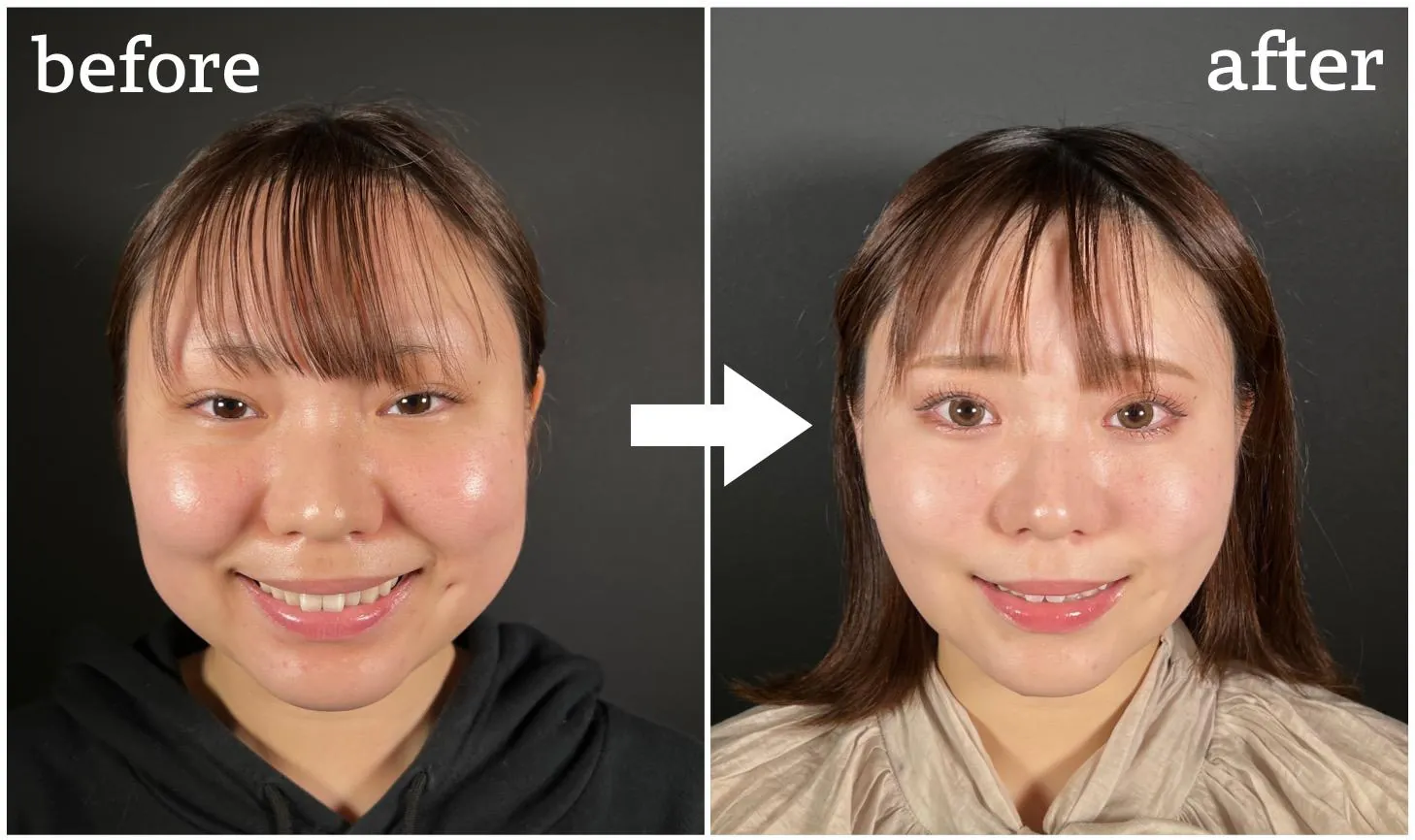 笑った時の頬の肉はなぜ盛り上がる？アンパンマン顔の原因と最新改善策
