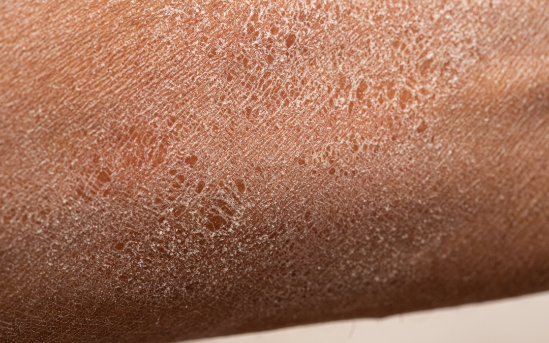 Does Hard Water Cause Itchy Skin