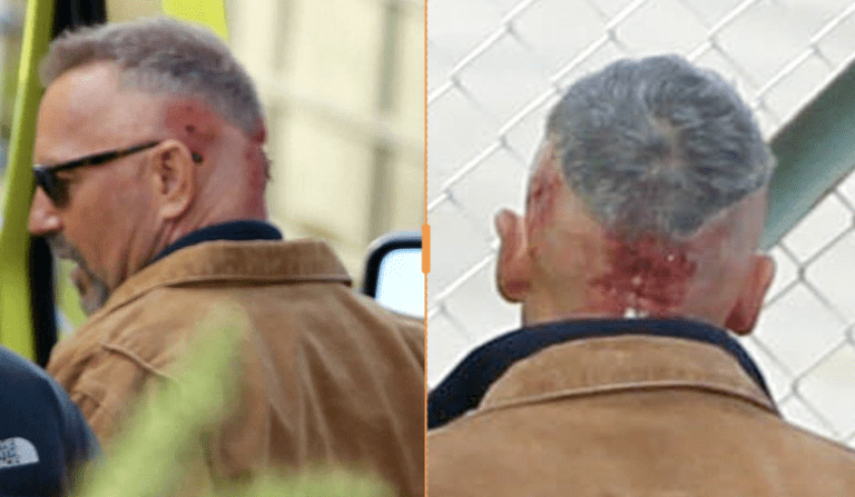 What Happened to Kevin Costner's Ear