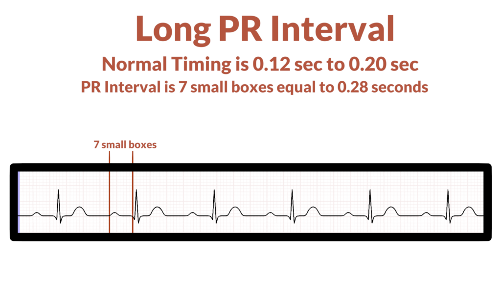 Ecg Long Pr Interval