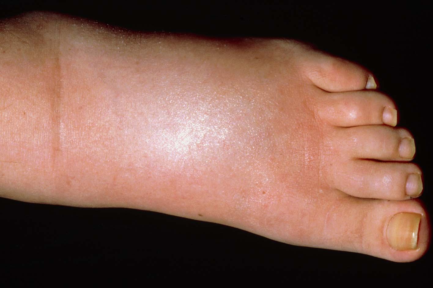 Swollen Ankles in Hot Weather Nhs