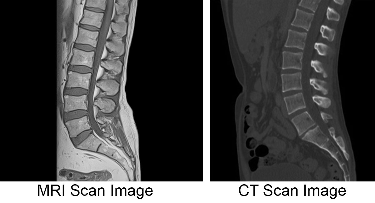 Ct vs Mri for Spine