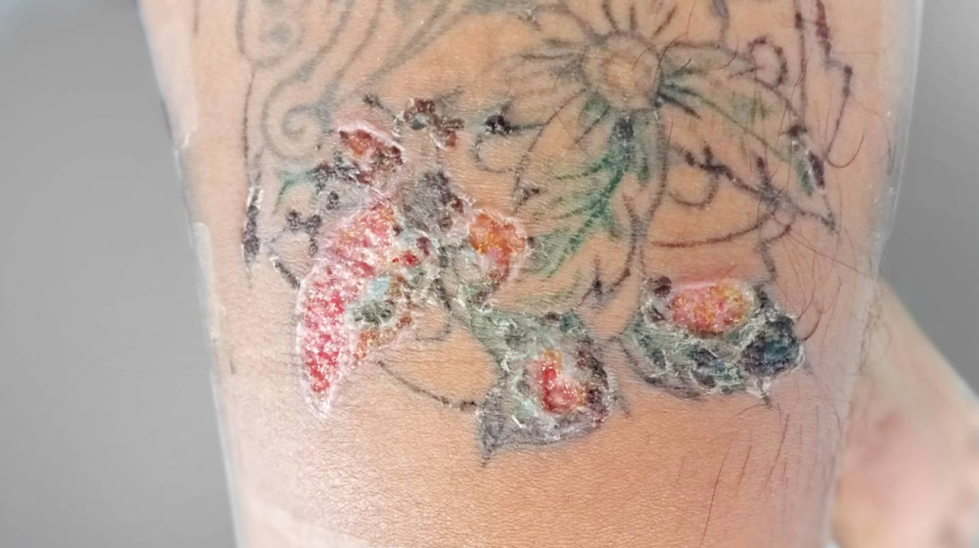 What to Do When Tattoo Is Infected