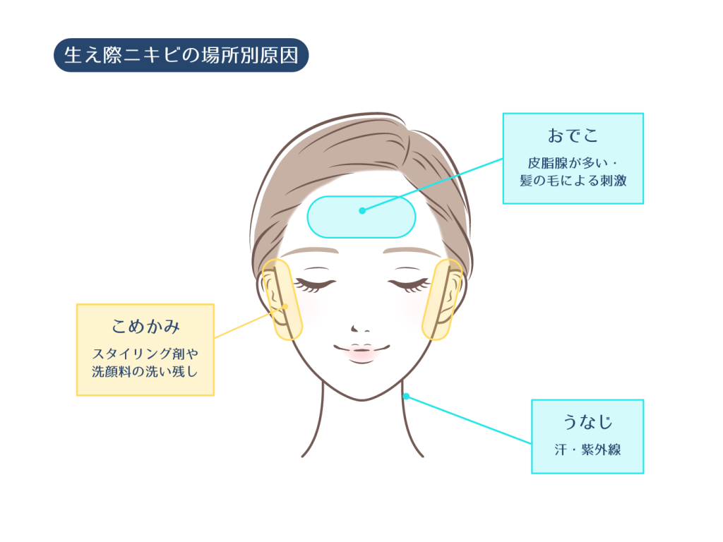 なぜ生え際ニキビは繰り返す？原因と皮膚科が教える2026年最新予防策