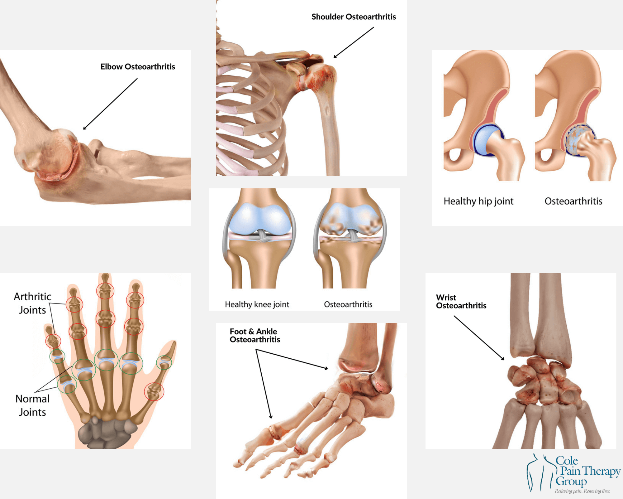 What Benefits Can I Claim If I Have Osteoarthritis