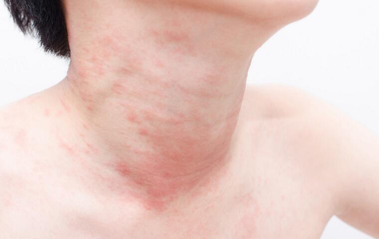 How to Get Rid of Skin Rash on Neck
