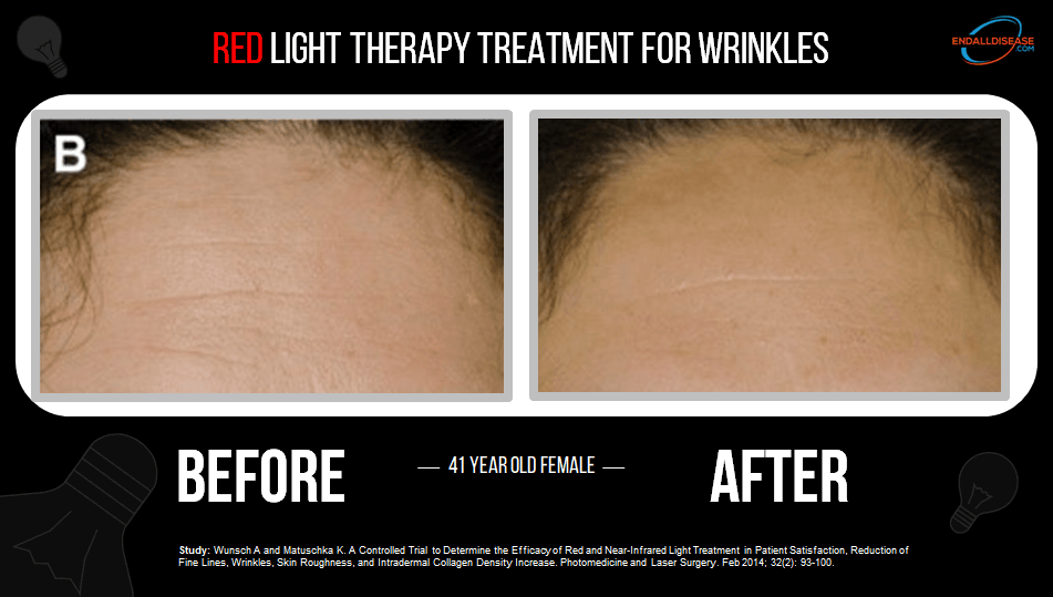 Red Light Therapy for Wrinkles Before and After