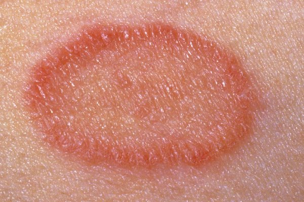 Red Splotches on Skin Not Itchy