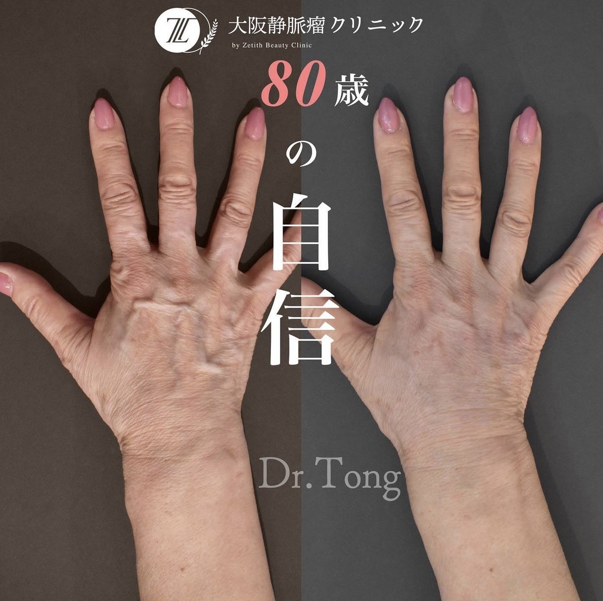 手の血管が浮き出る原因と病気のサイン｜最新ハンドベイン治療とケア法