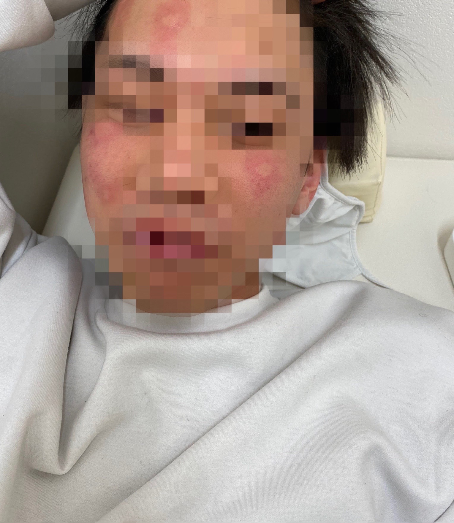 急な顔の蕁麻疹なぜ？原因の特定と腫れ・赤みを抑える最新対処法