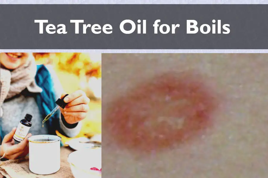 Home Remedies for a Boil