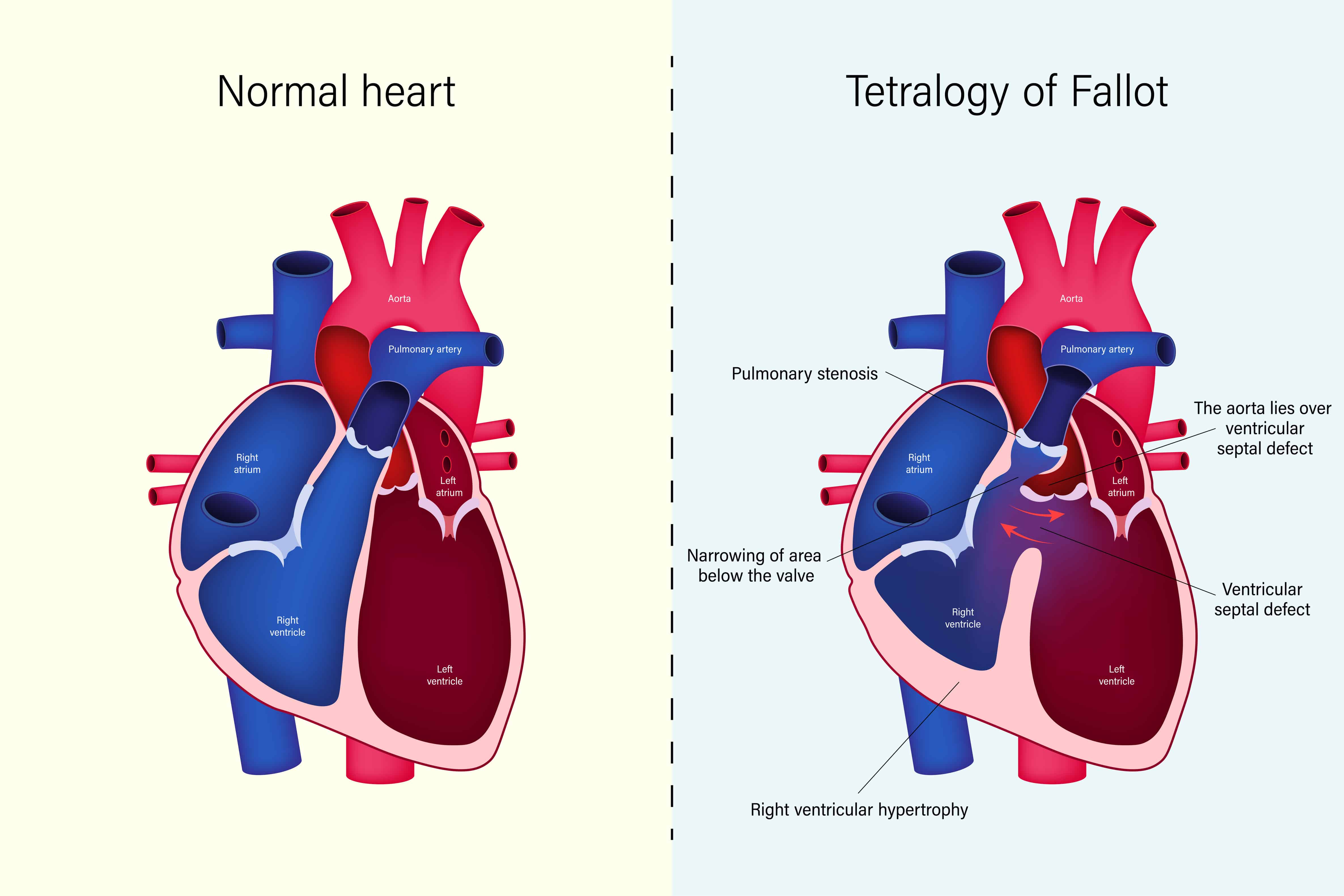 Oldest Living Person with Tetralogy of Fallot