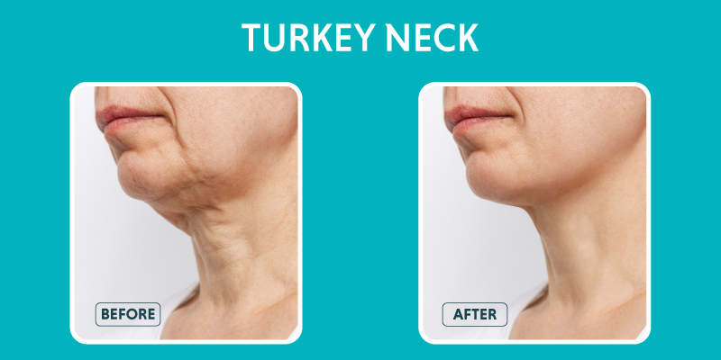 What Is the Skin on a Turkey Neck Called