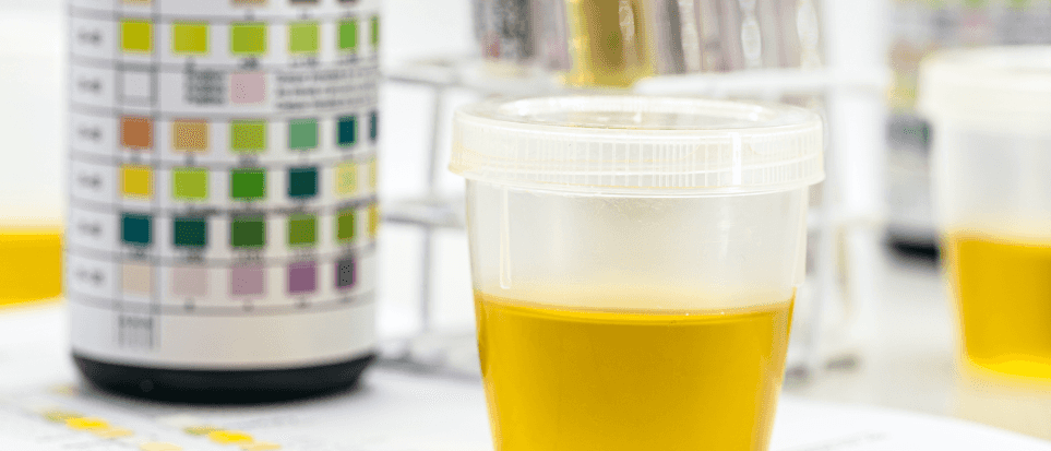 How Do You Store Urine for a Drug Test