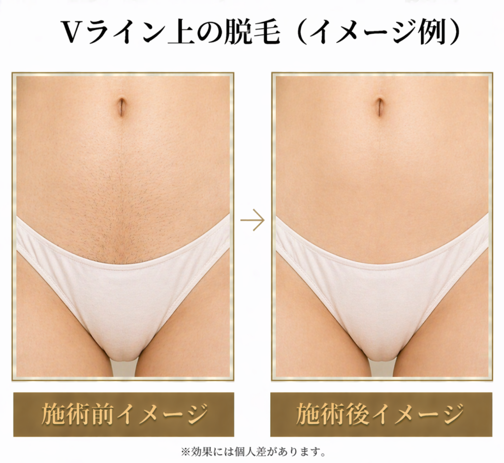 Vライン脱毛の写真で見る実際の効果と経過｜後悔ゼロの回数・デザイン術