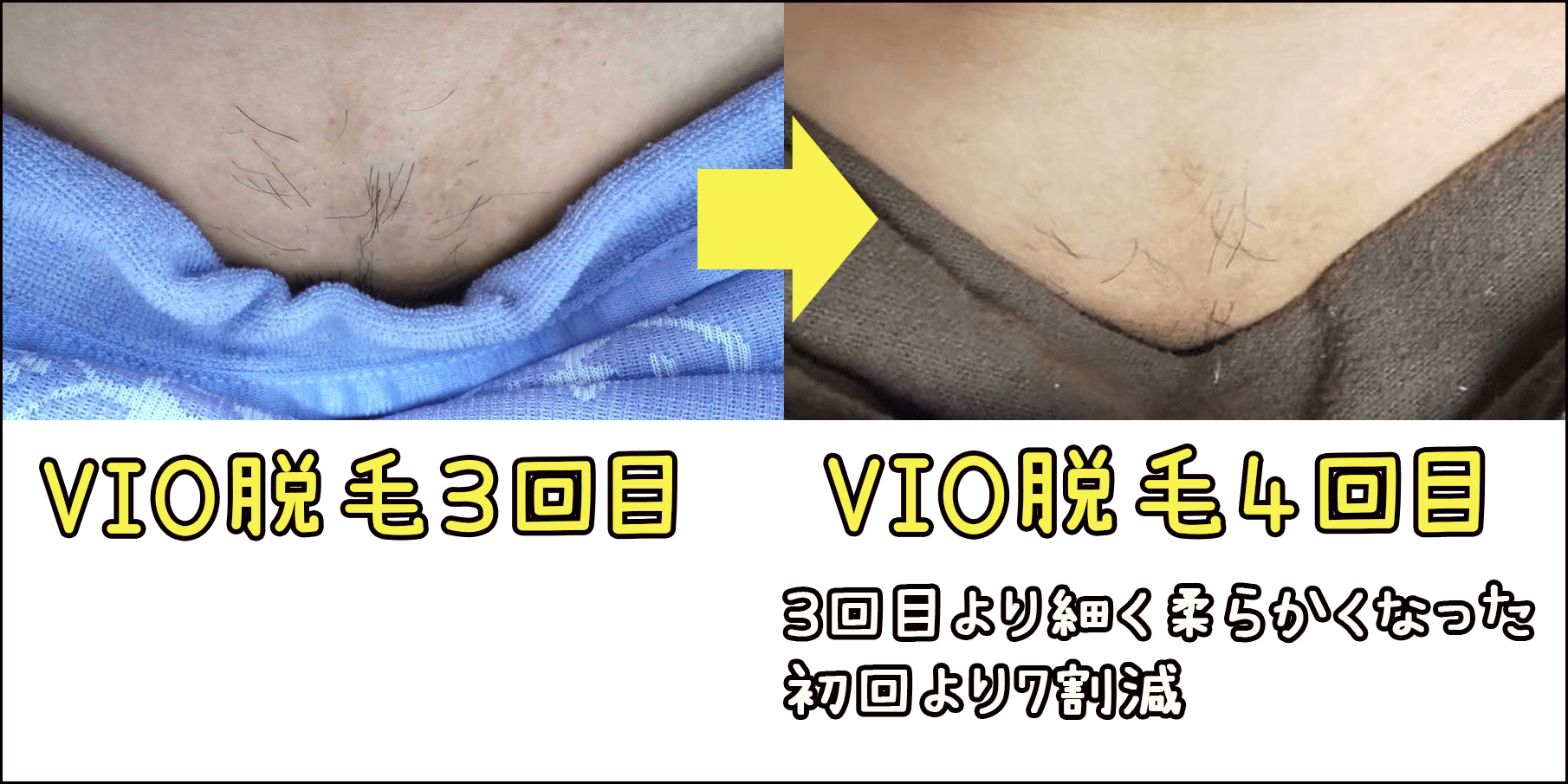 医療脱毛Vioの経過写真を検証！何回でツルツル？抜ける時期と痛みの真実