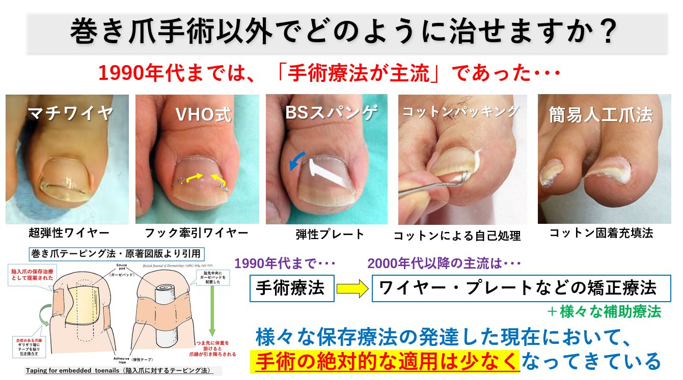 陥入爪手術の体験談と真実｜麻酔の激痛や術後経過・後悔を防ぐ選び方