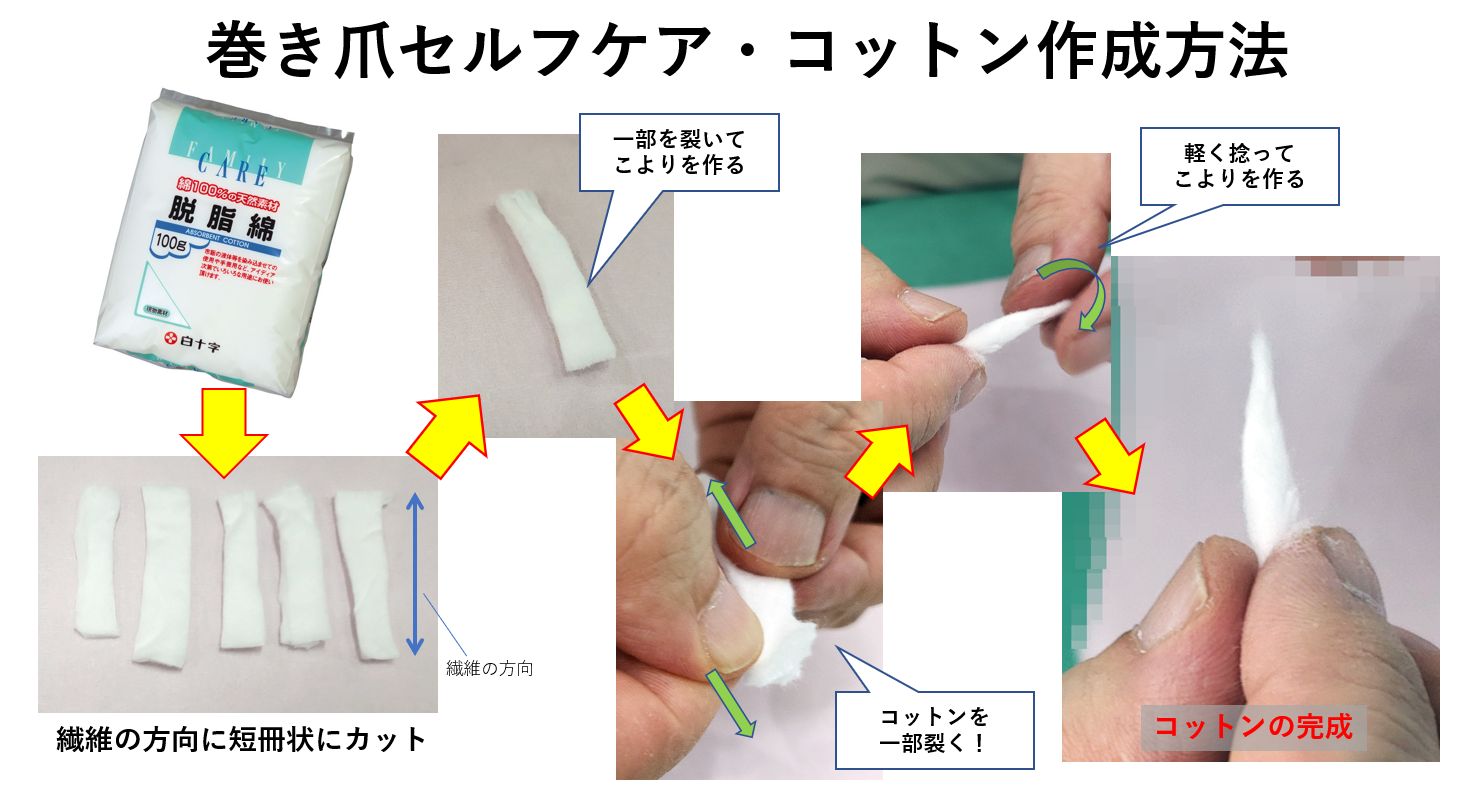 巻き爪のコットンはなぜ痛みが消える？正しい詰め方と悪化の罠