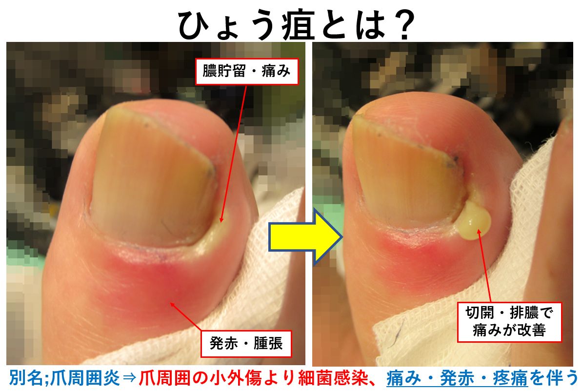 爪の横がズキズキ痛む爪周囲炎！市販薬の選び方と皮膚科受診の目安