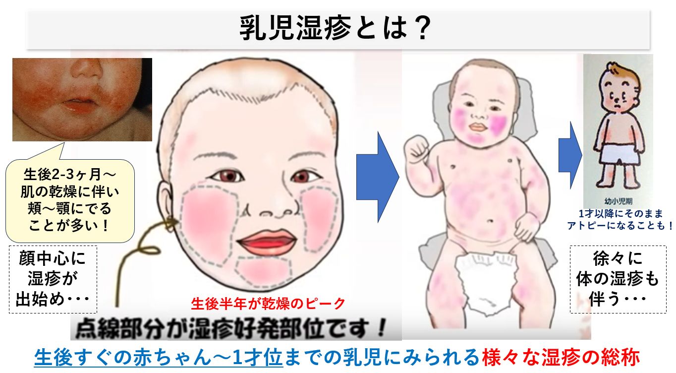 乳児湿疹の治し方2026最新！肌荒れが悪化する理由と病院受診の目安