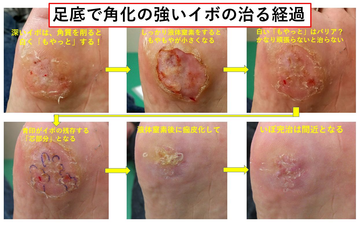 イボが液体窒素で取れるまでの全経過！ポロリの瞬間と痛みの真相