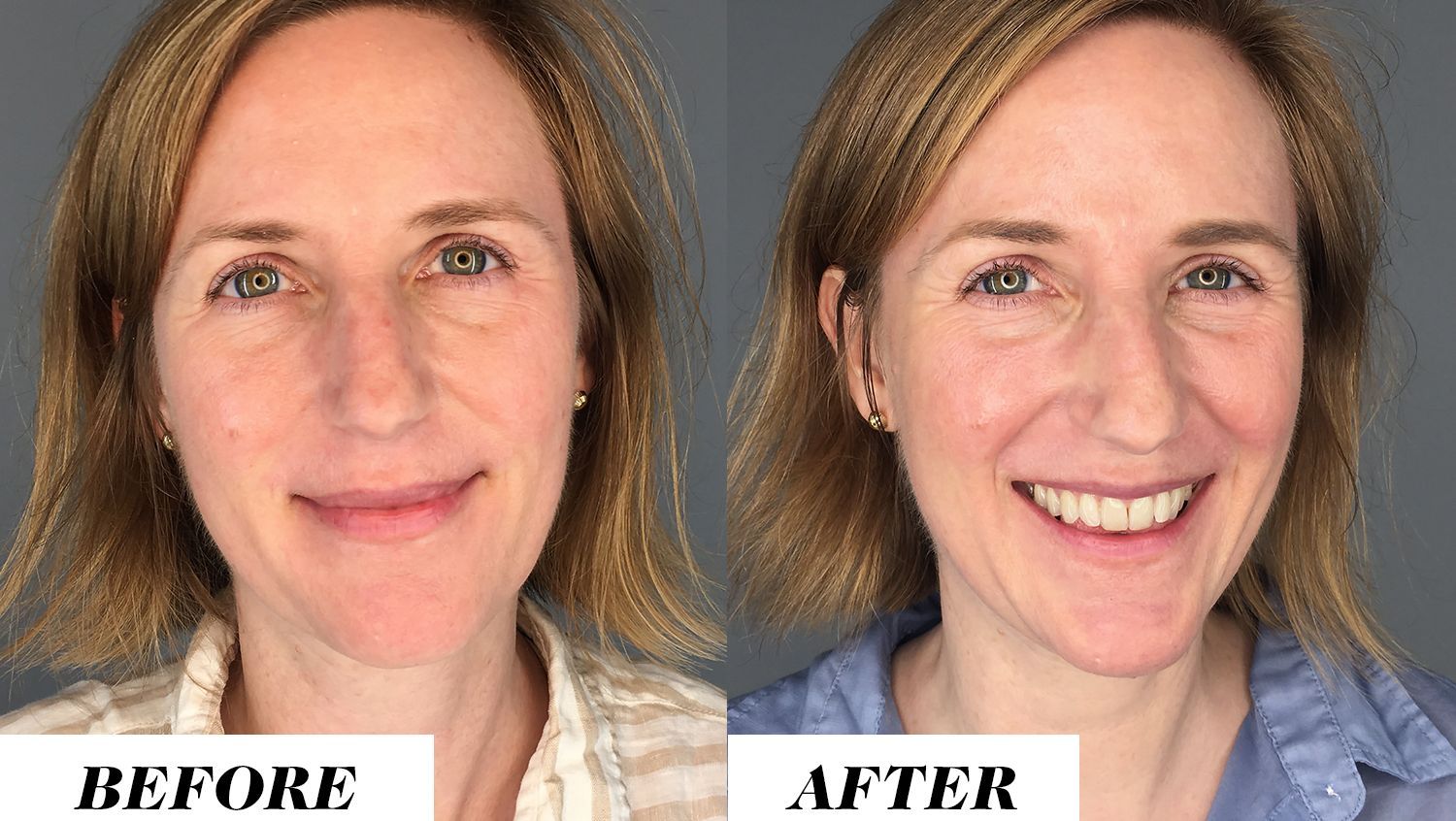 Drinking Water for Skin Before and After