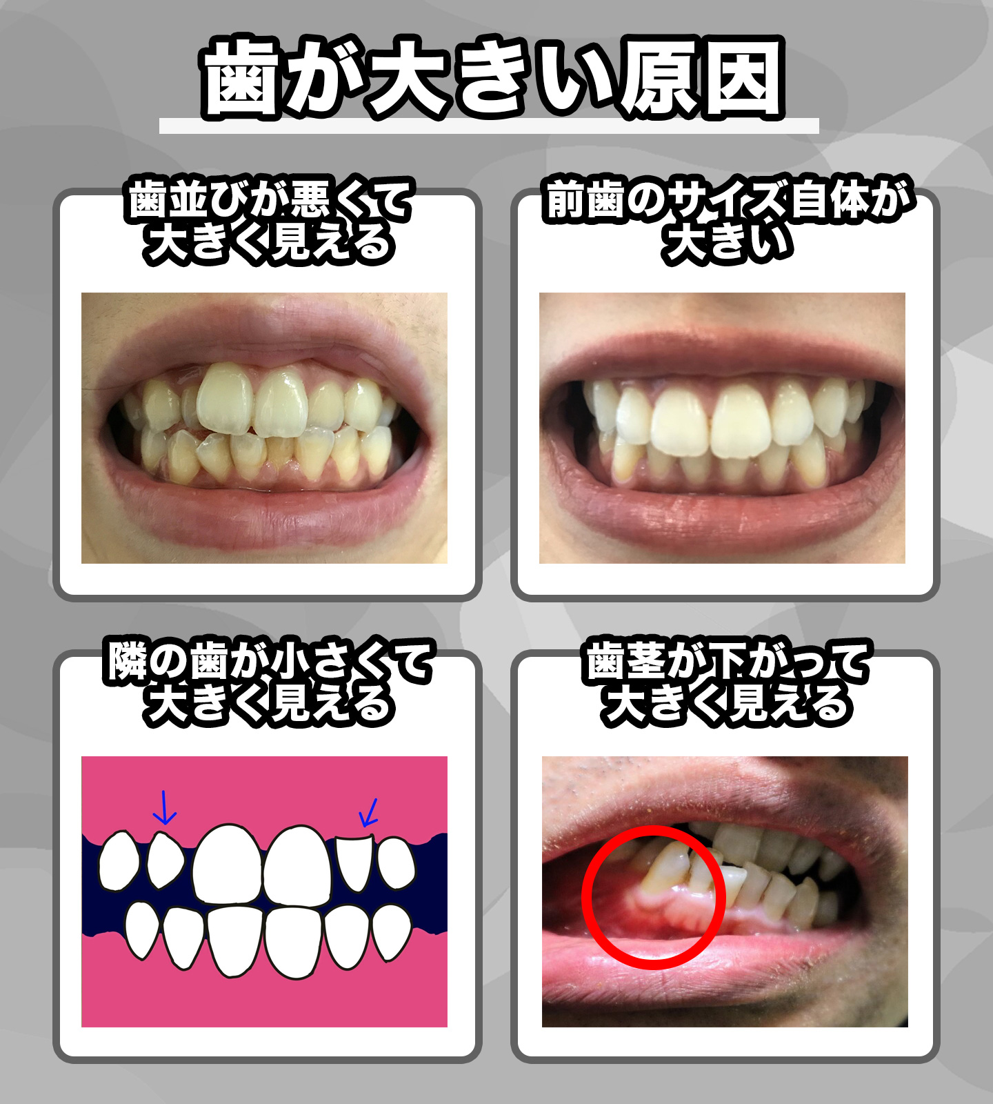 大きい前歯を削る費用相場と失敗リスク｜保険適用の真相を徹底解説