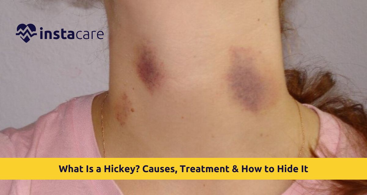 What Is a Hickey on Neck