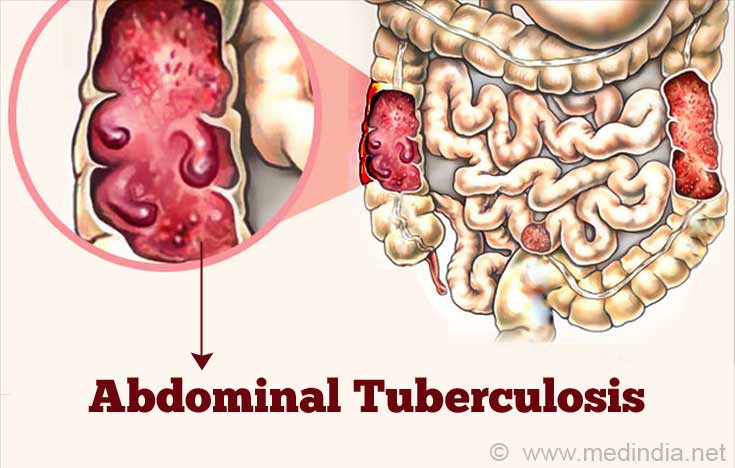 Tuberculosis of the Abdomen