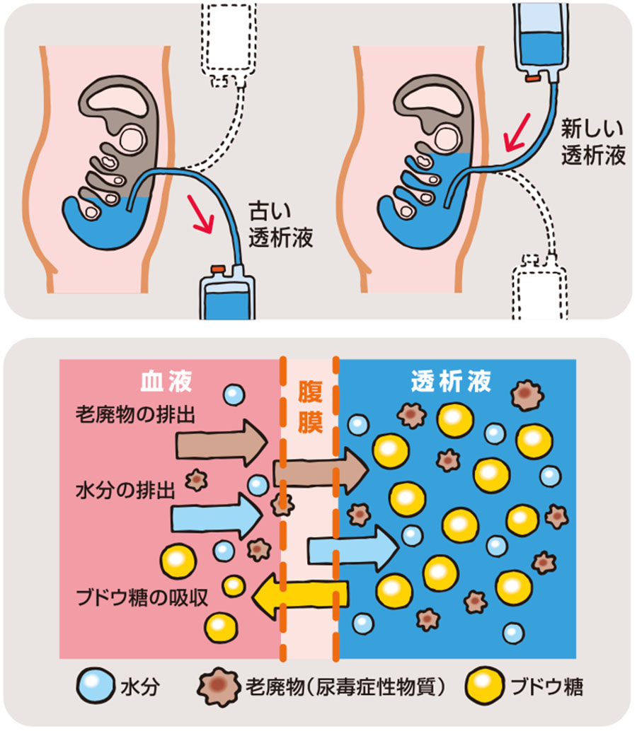 腹膜透析のやり方と生活の実際｜Capd・Apdの手順や費用を徹底解説