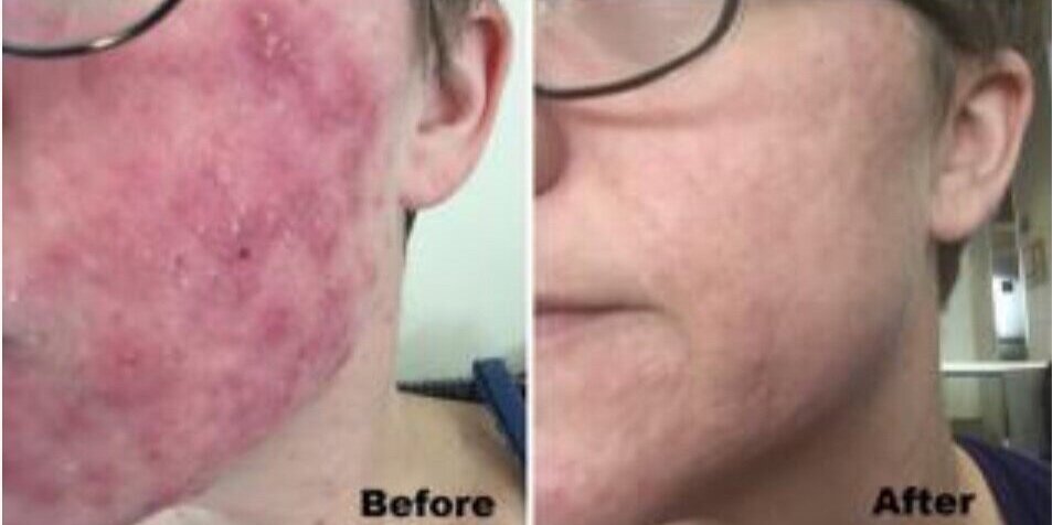 Red Light Therapy Scars Before and After