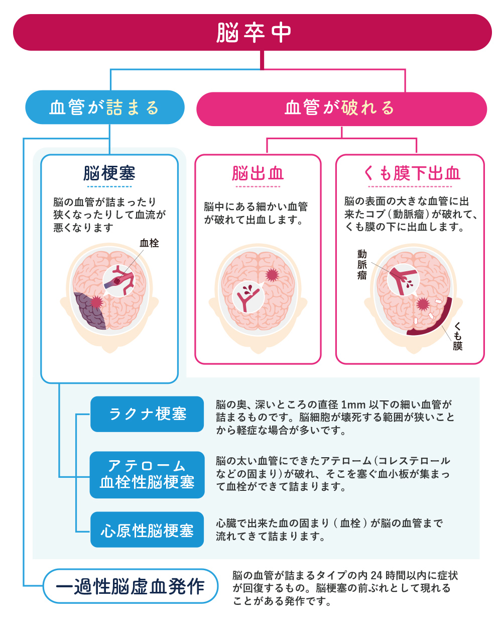 ラクナ梗塞とは？軽視禁物の初期症状と再発予防策を専門記者が徹底解説
